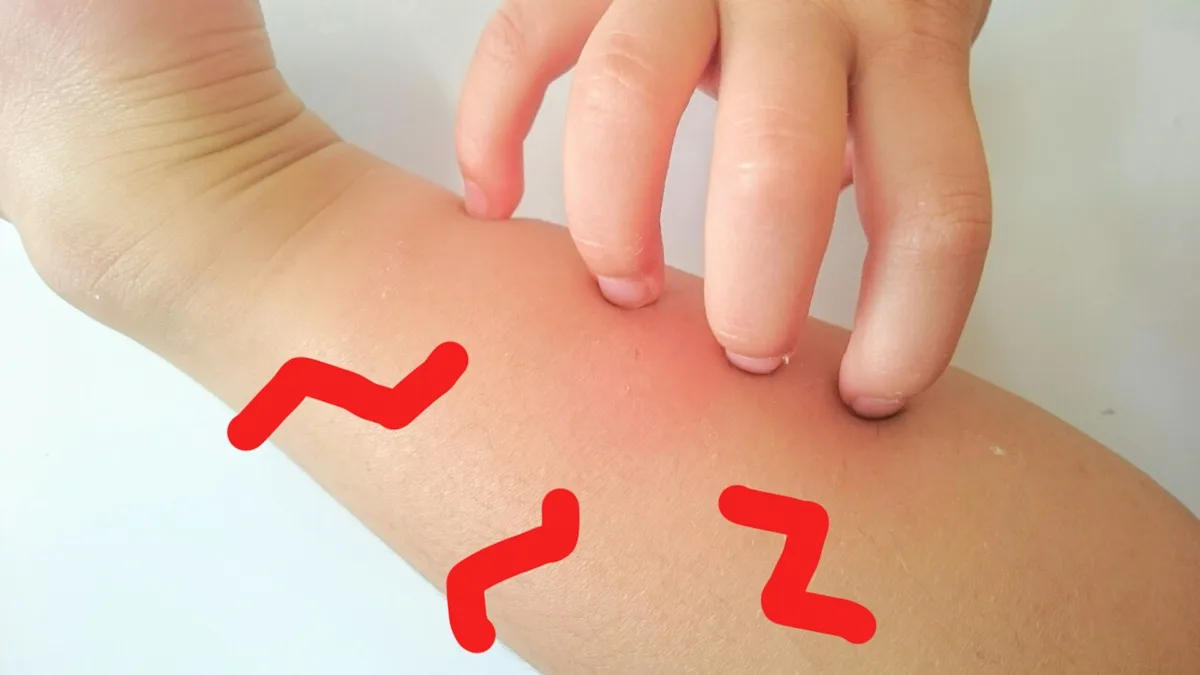 ハチに刺されたときの応急処置と病院に行くべき症状